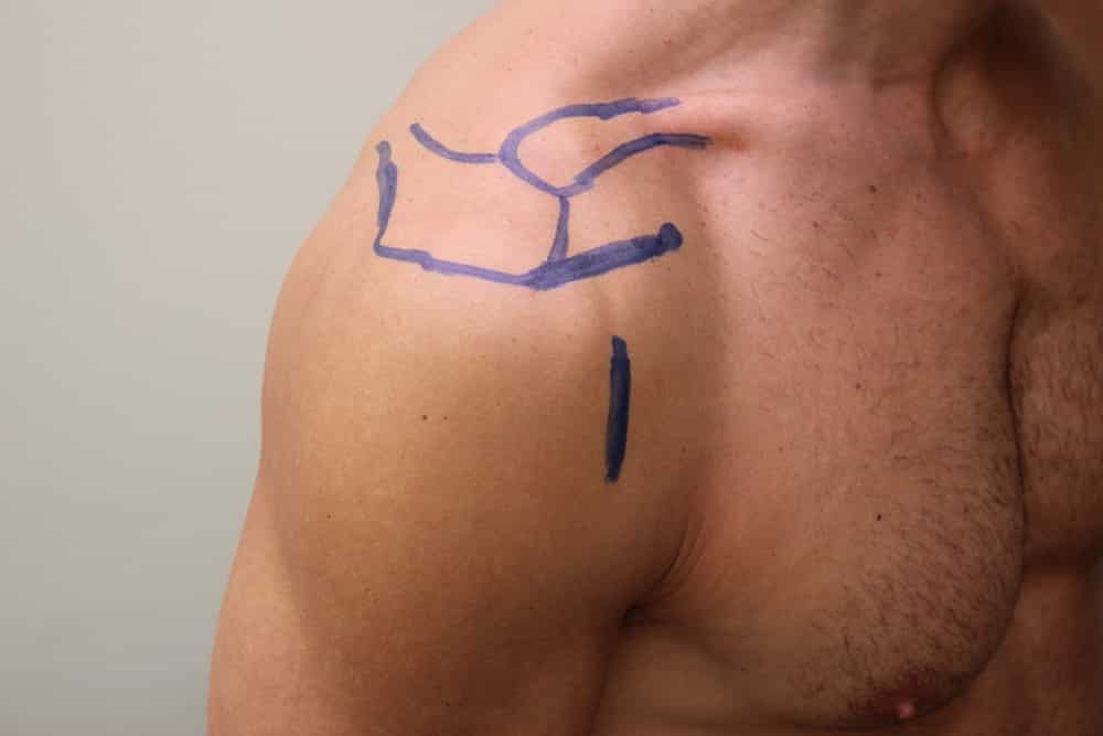 Représentation de l'acromion, la clavicule, la coracoïde et le ligament acromio-coracoïdien. En avant la longue portion du biceps.