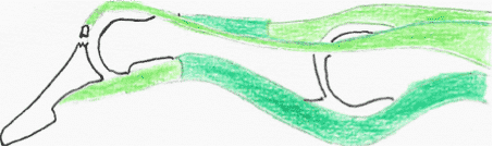 Mallet Finger osseux: désinsertion du tendon emportant un fragment osseux.