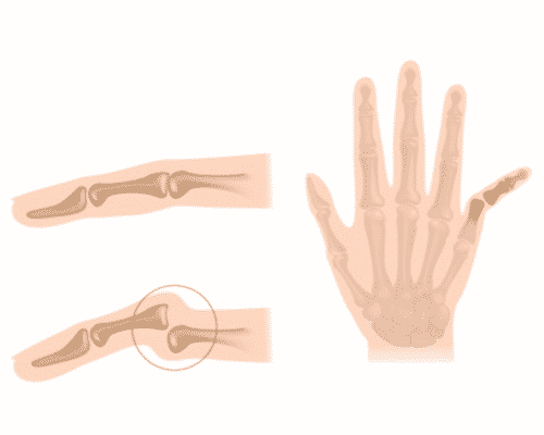 dessin illustrant une luxation de doigt au niveau de l'articulation inter-phalangienne proximale.