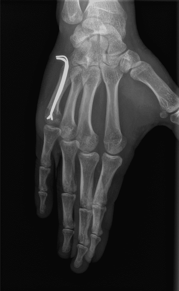Radiographie d'un embrochage type