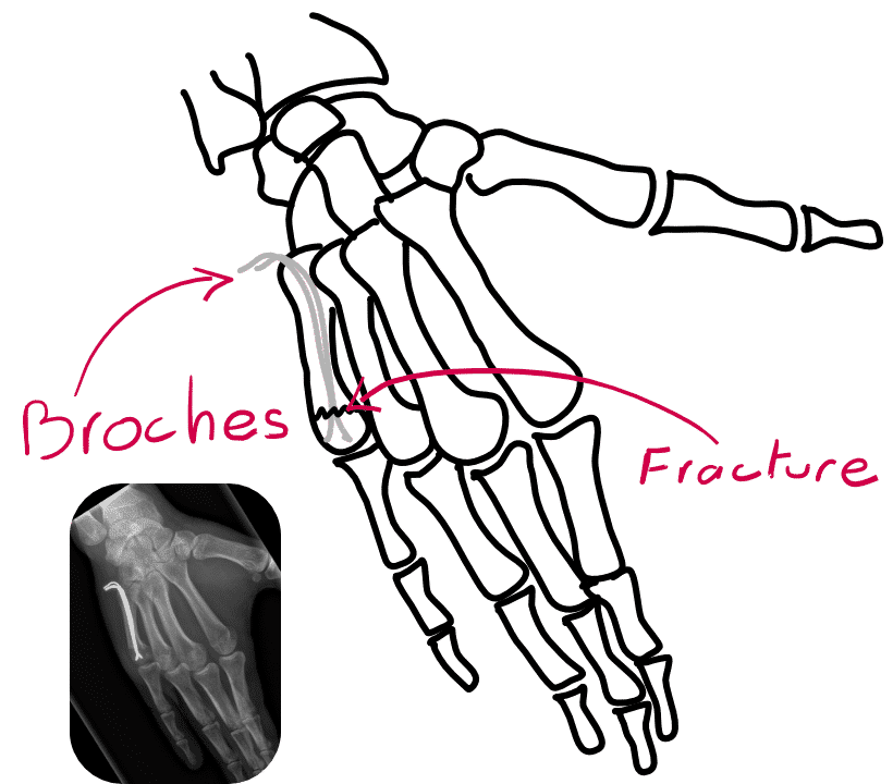 Les fractures de métacarpiens des doigts longs MembreSuperieur