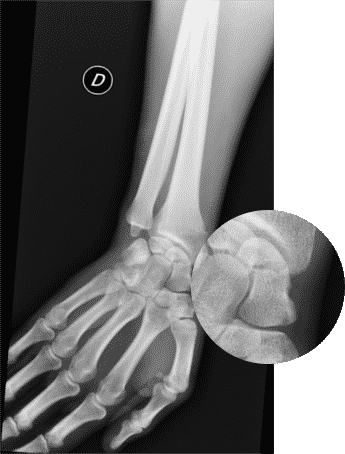 Zoom sur une fracture du scaphoïde