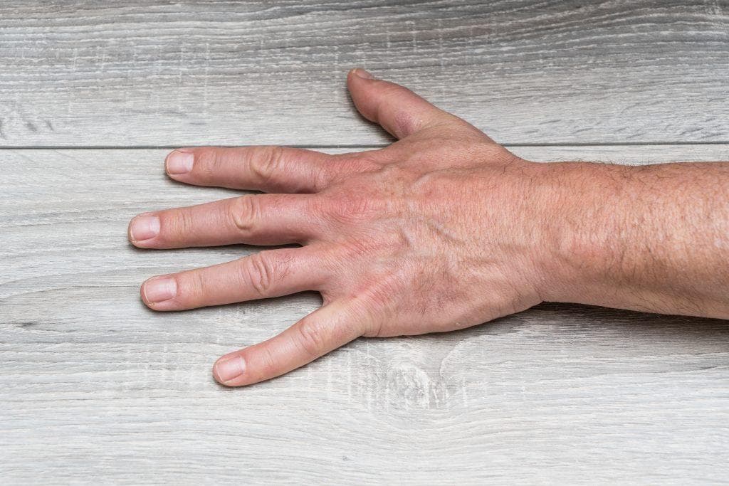 Main à plat sur une table: la maladie de Dupuytren ne nécessite aucun traitement