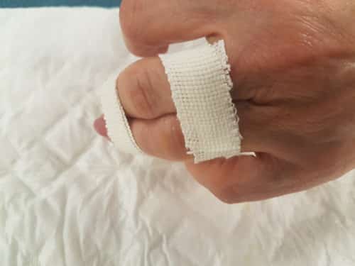 La syndactylie doit respecter la mobilité articulaire