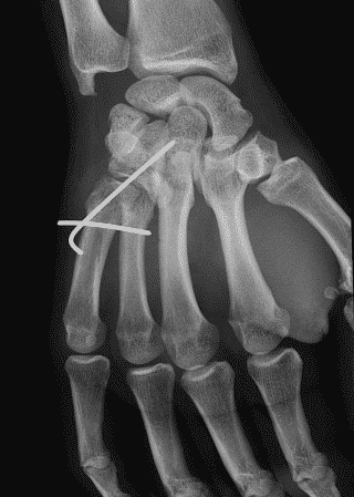 Radiographie d'un brochage pour fracture de la base d'un 5ème métacarpien