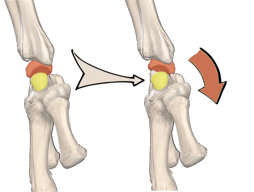 Poignet de profil, le scaphoïde étant retiré: avec une disjonction scaphoïde-lunaire, le lunatum tend à l'extension