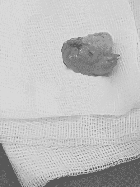 Kyste synovial de poignet après éxérèse.