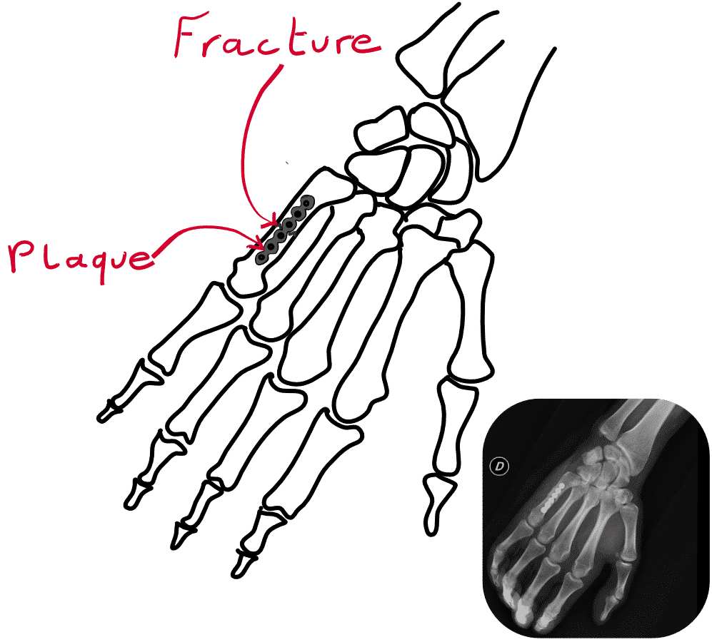 Dessin et radiographie d'une ostéosynthèse de métaphyse d'un métacarpien, par plaque
