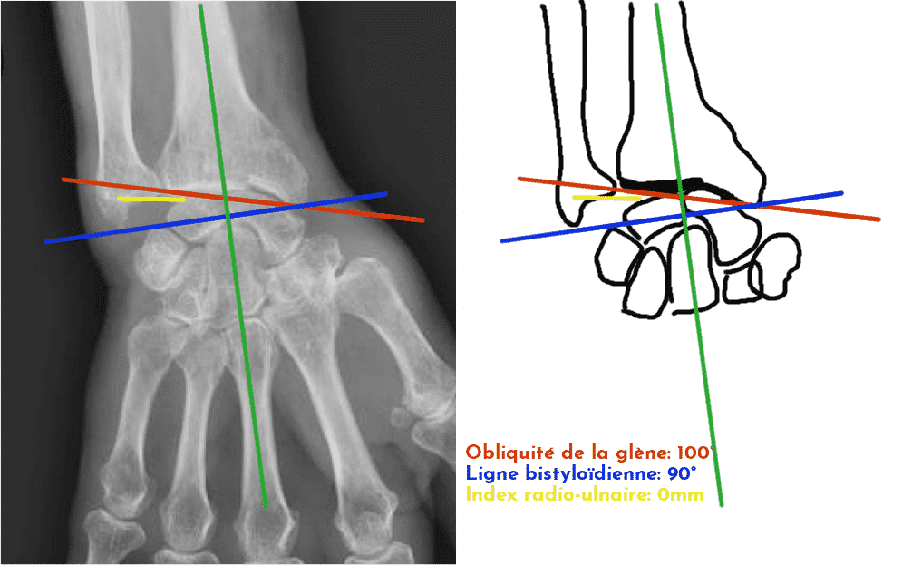 Poignet fracturé de face