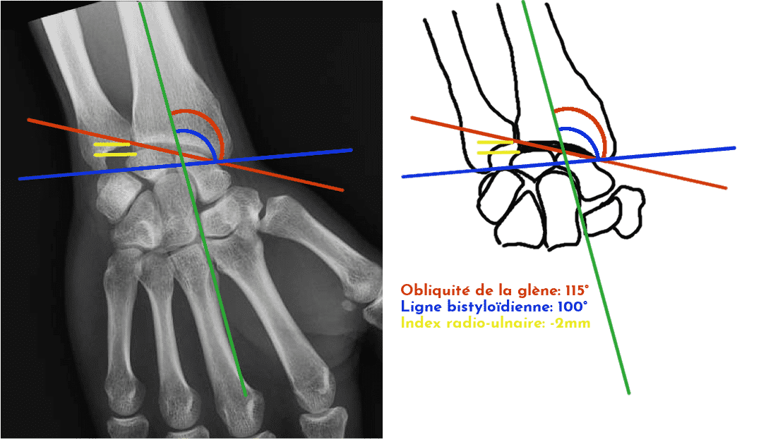 Les fractures du poignet - Membre-Superieur