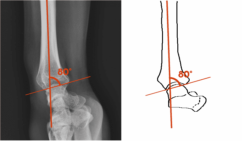 Radiographie de profil d'un poignet normal.