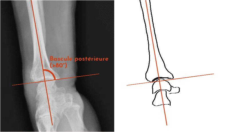 Radiographie d'un poignet fracturé, de profil