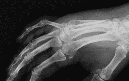 Fracture de la base de la première phalange du 5ème doigt, vue de profil