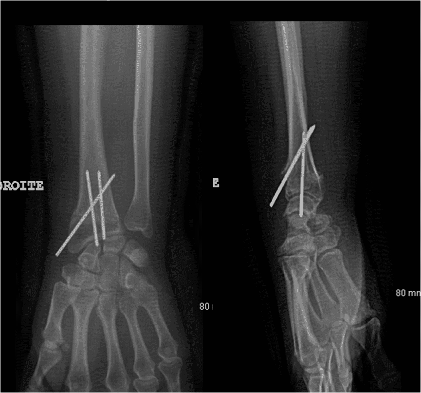 Radiographie d'un brochage de poignet