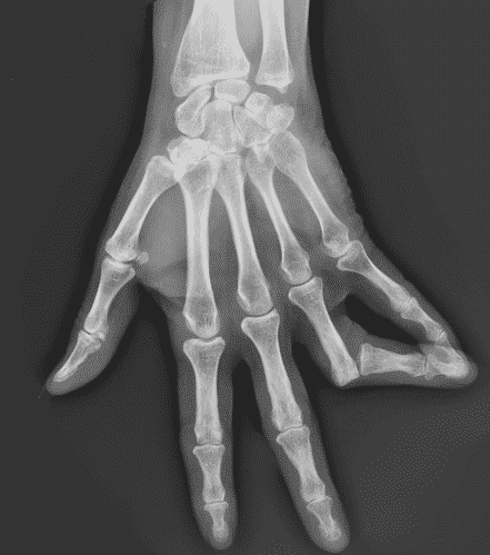 radiographie d'un doigt luxé