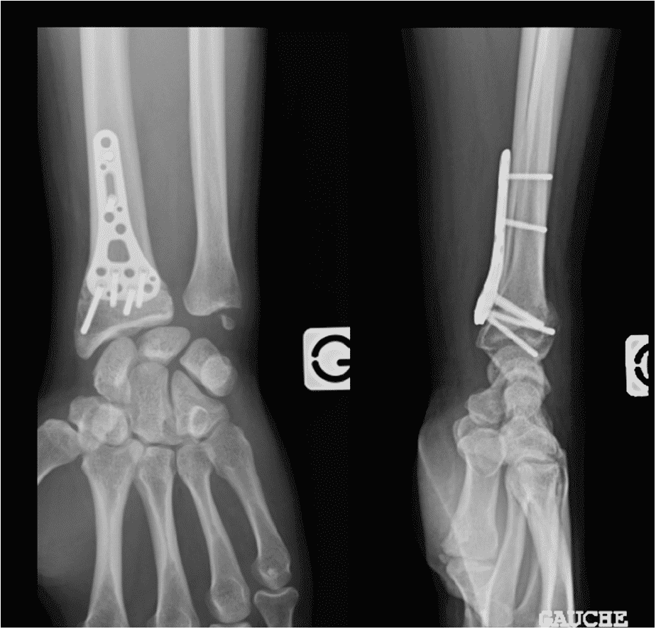 Radiographie d'une plaque de poignet