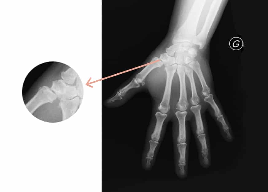 Radiographie montrant une rhizarthrose