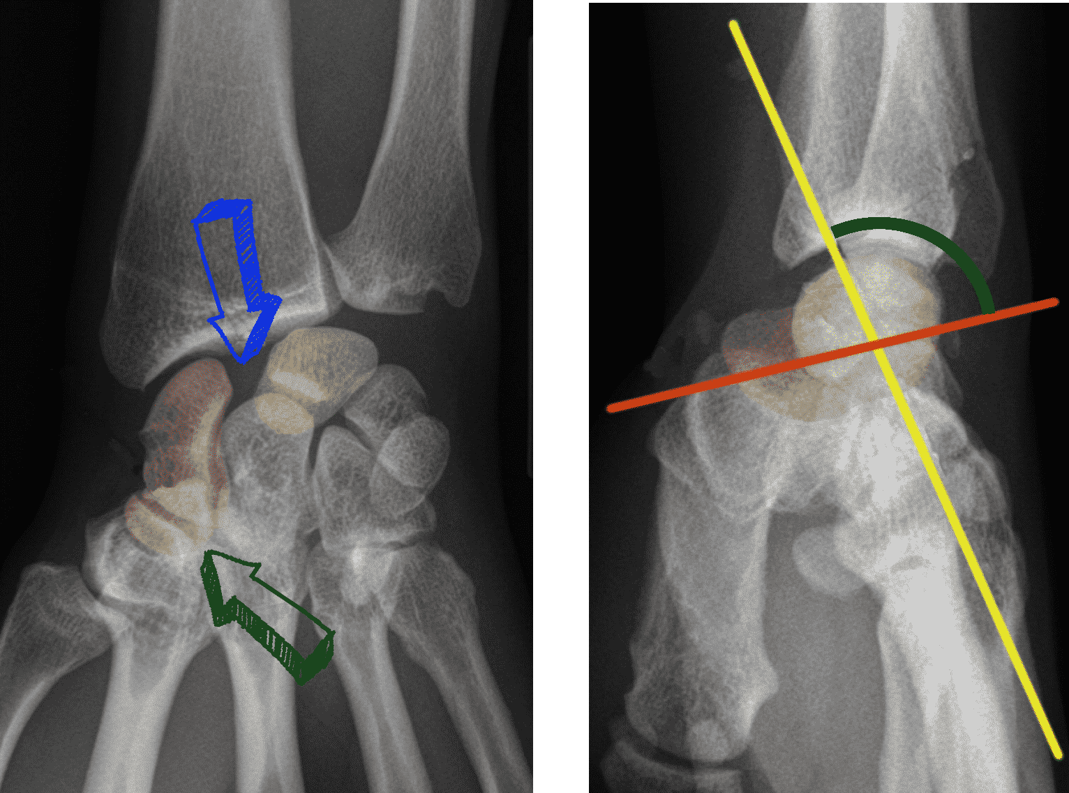 En rouge le scaphoïde, en jaune le lunatum. Sur la radiographie de face on visualise ici un diastasis scapholunaire (flèche bleue) et un signe de l'anneau (flèche verte). De profil, l'angle scapholunaire est supérieur à 70° (normale30 à 60°).