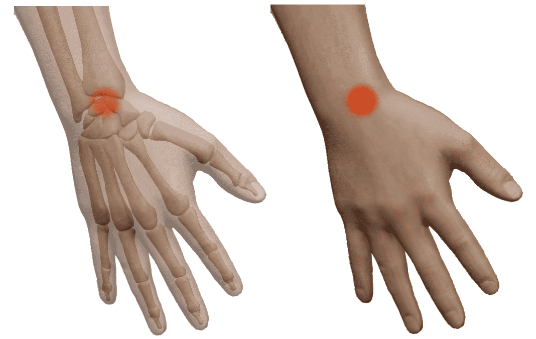 Repère externe du point douloureux et tuméfié lors d'une entorse scapho-lunaire.