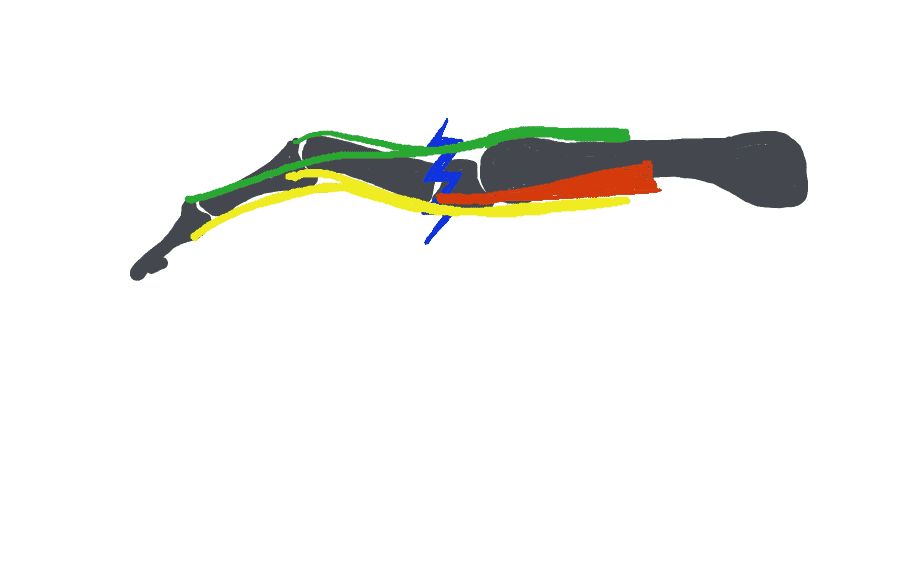 Schématisation d'une fracture de la base de la première phalange: En bleu le trait de fracture, en rouge les interosseux, en vert les tendons extenseurs, en jaune les tendons fléchisseurs.