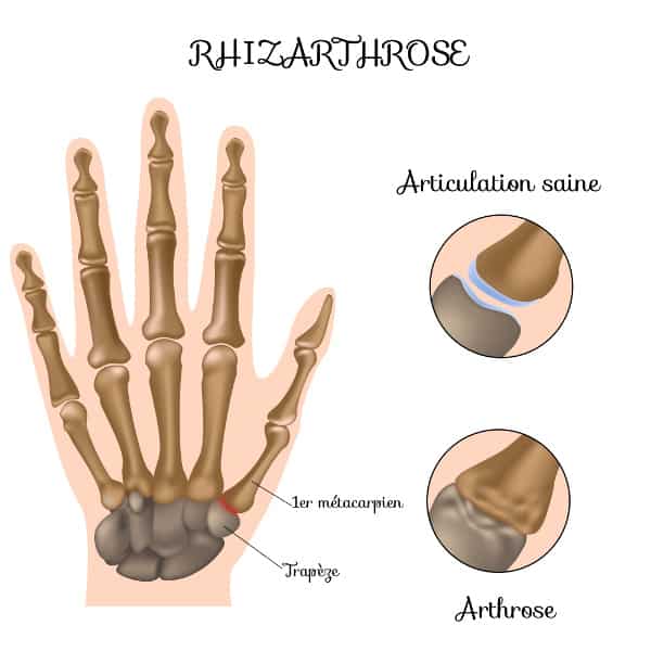 La rhizarthrose correspond à une usure du cartilage entre le 1er métacarpien et l'os trapèze