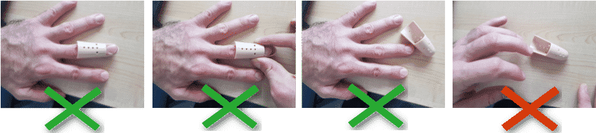 Guide de bonne conduite dans le traitement du Mallet Finger: nettoyer l'attelle de Stack. Le doigt doit toujours rester en rectitude lors du traitement des Mallet Fingers, sans aucune exception.