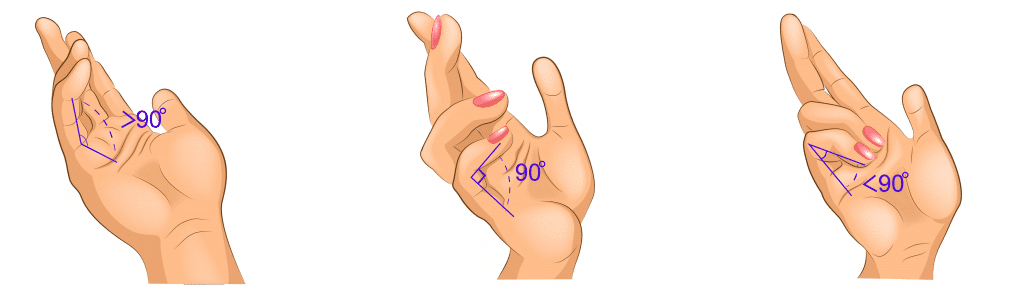 Exemples de mesures de rétraction articulaire. A gauche l'articulation métacarpo-phalangienne s'ouvre à plus de 90°, sa rétraction est donc inférieure à 90°. A droite le contraire.