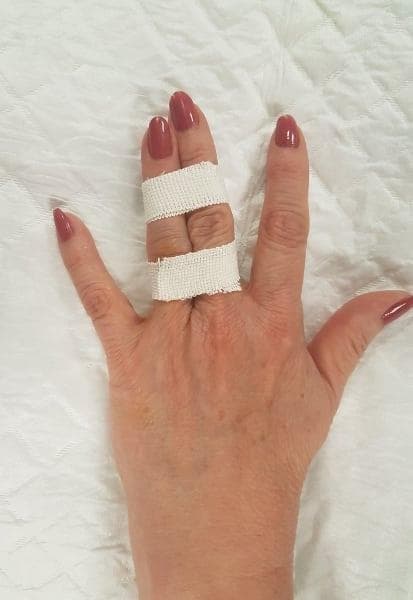 Syndactylie après luxation