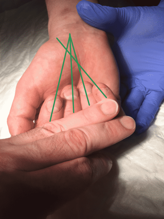 Illustration d'un trouble de rotation après fracture du 5ème métacarpien