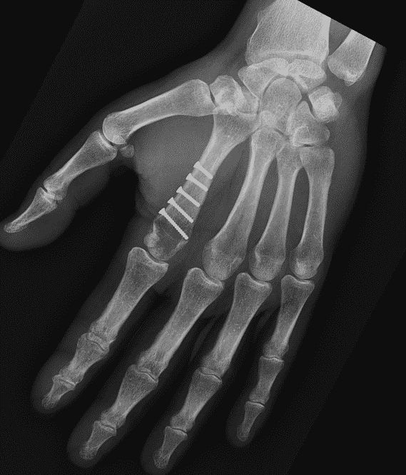 Radiographie d'un vissage d'une fracture de 2ème métacarpien