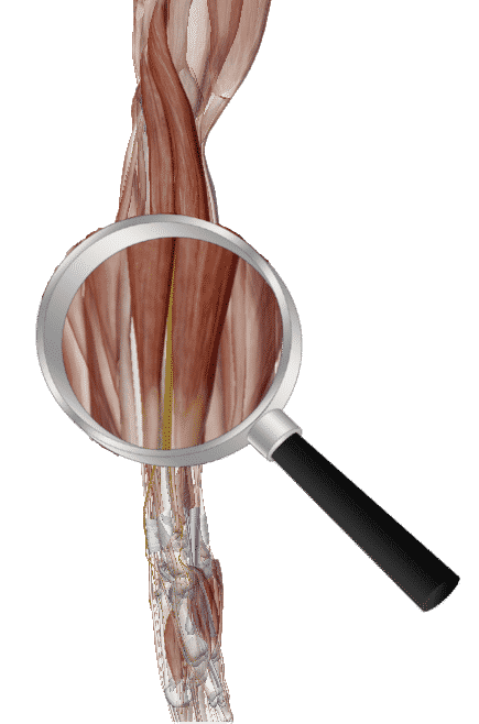 La branche superficielle du nerf radial émerge entre le muscle long extenseur radial du carpe (ECRL, à gauche) et brachio-radial (à droite)