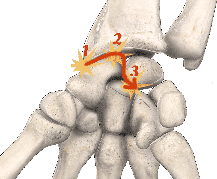 L'arthrose post-traumatique - IM2S